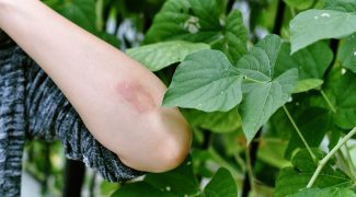 Considerations for Using Plants That Can Cause Skin Irritation Featured Image