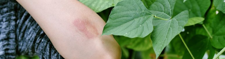 arm brushing up against plants that cause skin irritation